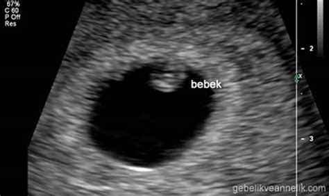 3 haftalık bebek ultrason görüntüsü